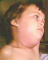 A little boy displaying mumps symptoms.